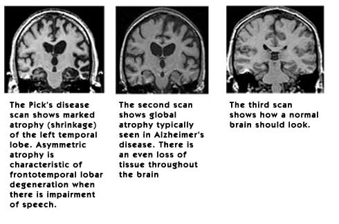 Alzheimer's MRI