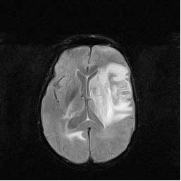 MRI showing stroke